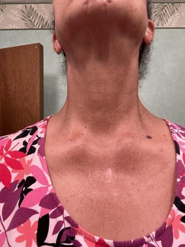 Customer photo: Lenny’s neck and chest