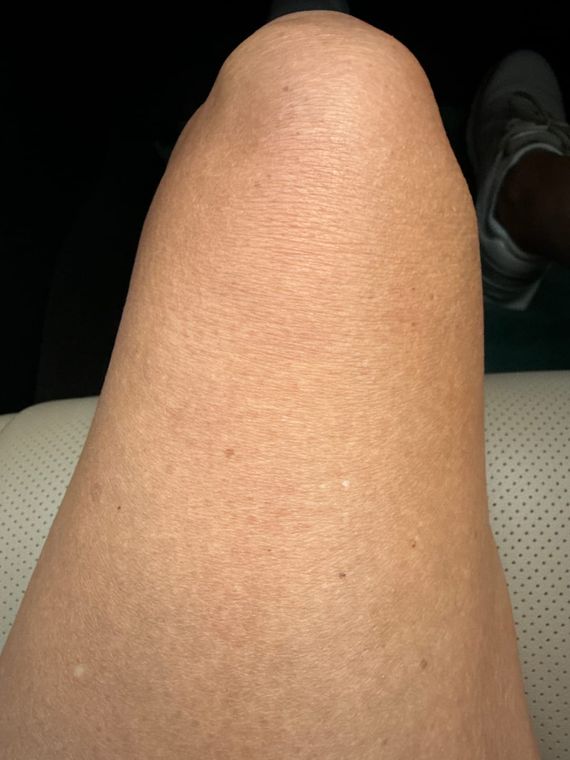Customer photo: Liz H.’s knee