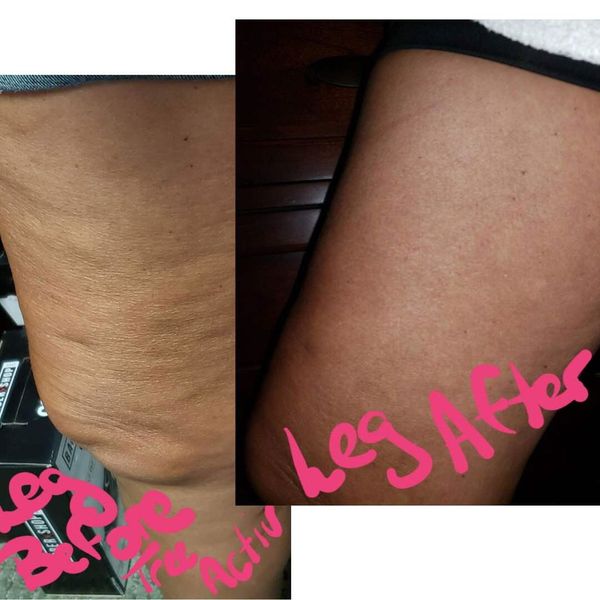 Customer photo: Joyce P.’s legs, before and after