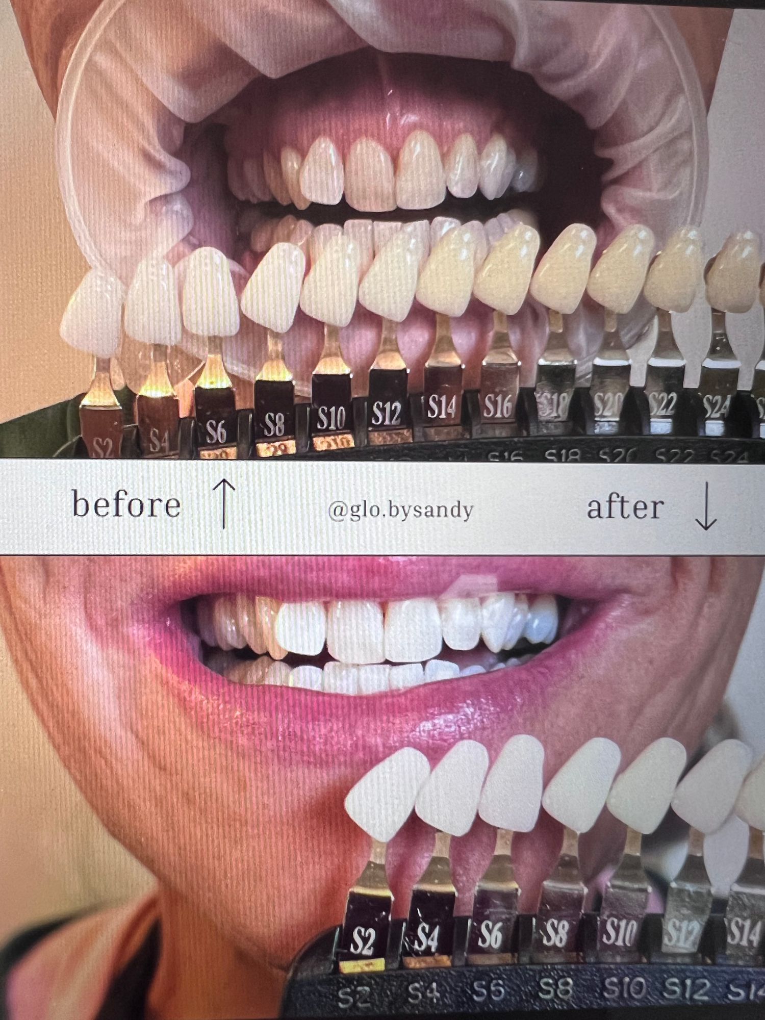 Super Gel Professional Whitening Kit