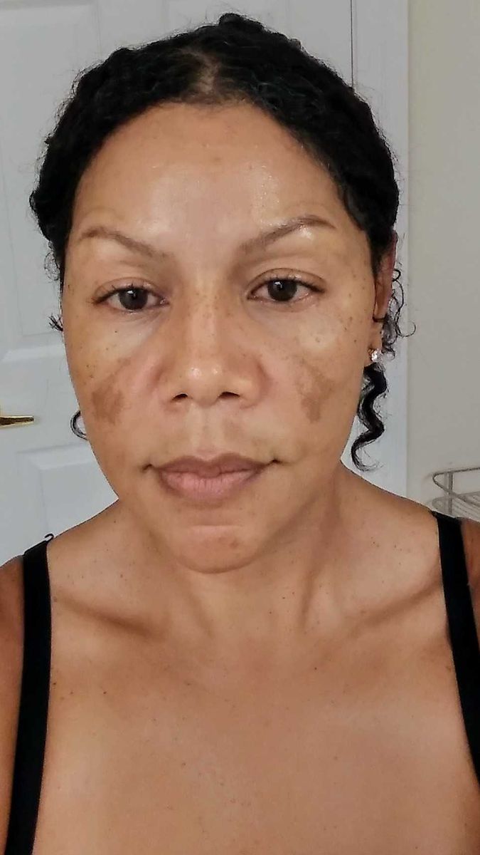 Before - Linda M.