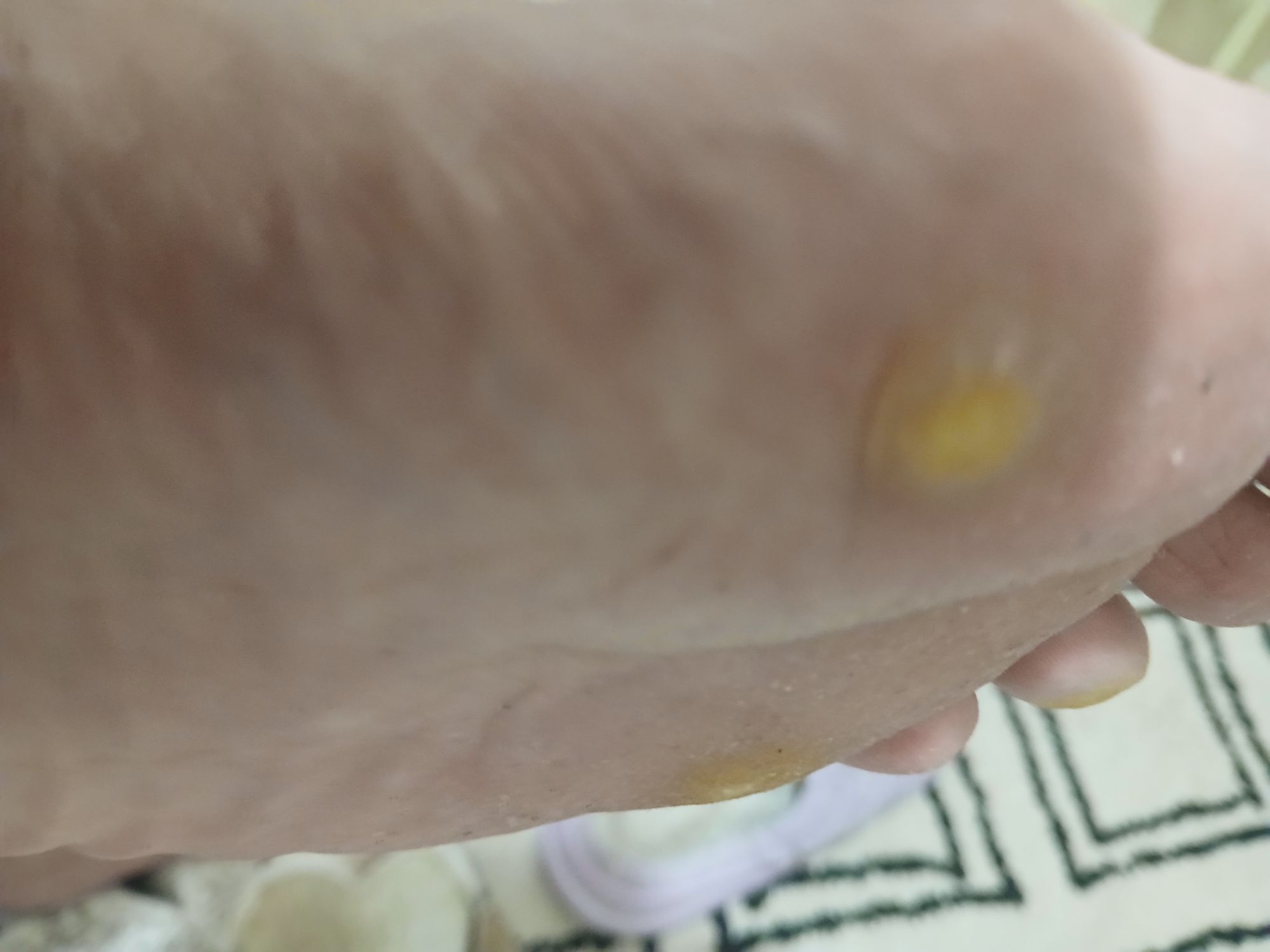 x products for calluses and corn on foot – Quick and easy fix