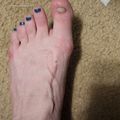 A foot with blue nail polish on the toes, showing what appears to be a damaged or missing toenail on the big toe