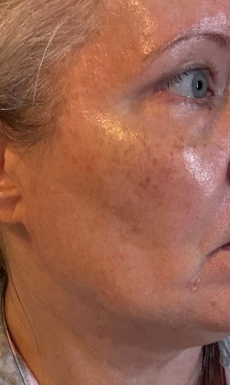glutathione drip skin brightening dubai uae effectiveness Glutathione IV Drip in Dubai
