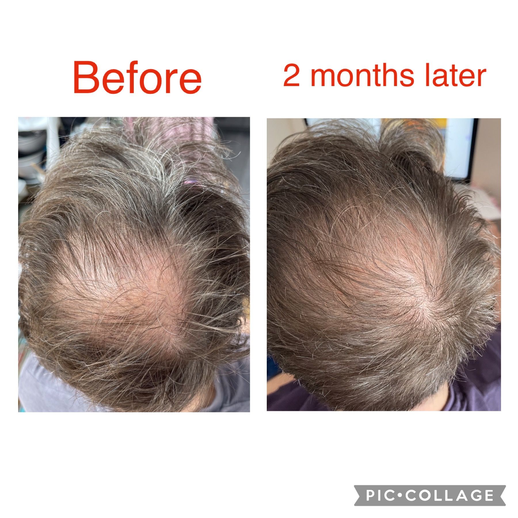 Red Light Therapy Hair Loss Helmet FDA Cleared Hair Growth