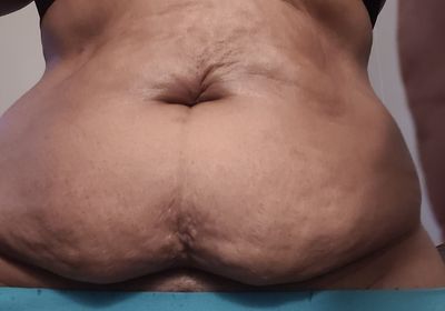 Customer-uploaded image. Click to see more details. The image represents: Medical or anatomical image showing skin condition or scarring on torso area