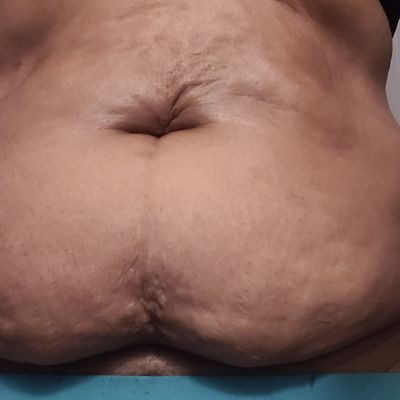 Customer-uploaded image. Click to see more details. The image represents: Medical or anatomical image showing skin condition or scarring on torso area