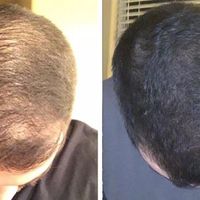 Customer-uploaded image. Click to see more details. The image represents: Before and after comparison showing hair loss treatment results on the crown of a person's head