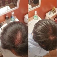 Customer-uploaded image. Click to see more details. The image represents: Before and after comparison showing hair treatment results with improved hair density and coverage