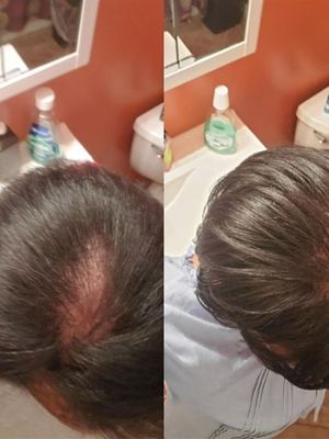 Customer-uploaded image. Click to see more details. The image represents: Before and after comparison showing hair treatment results with improved hair density and coverage