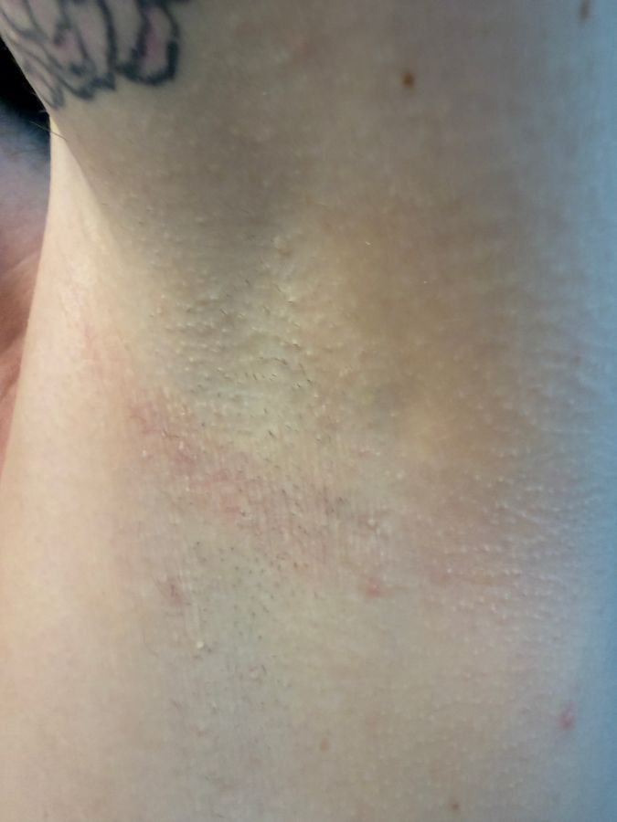 Customer photo showing calm, healed underarm skin after using MAGS Skin