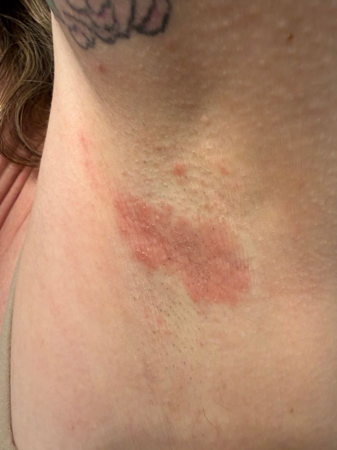 Customer photo showing a red, irritated rash on the underarm before using MAGS Skin