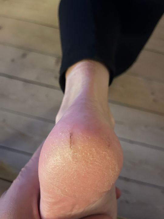 products for hard skin on feet and heels Quick Easy