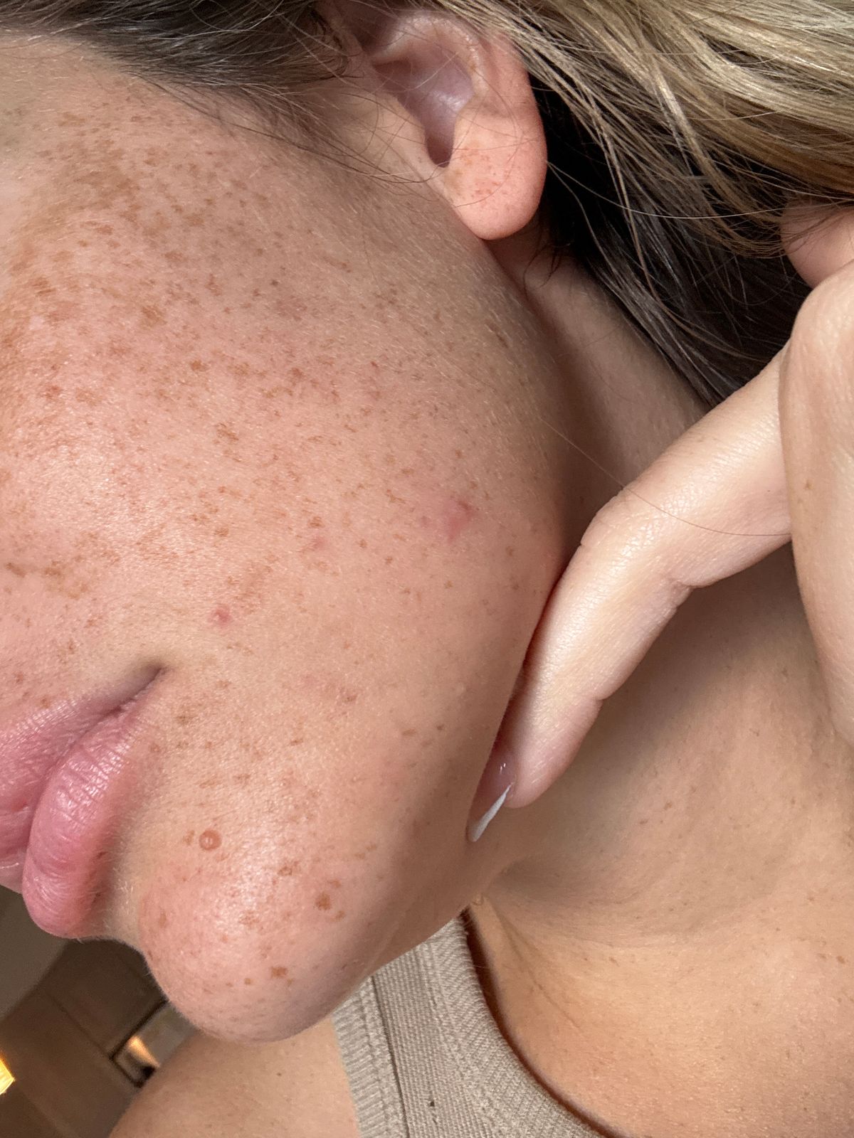A close-up profile view of a person's face and neck area showing skin texture and freckles